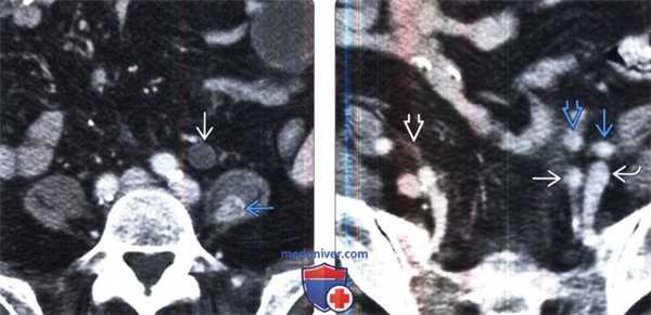 КТ, МРТ при забрюшинных метастазах