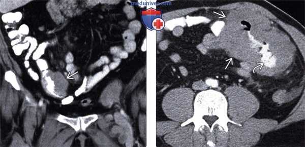 КТ, УЗИ брюшной полости при лейкемии и лимфоме