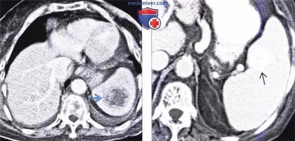 КТ, МРТ, УЗИ, ПЭТ при метастазе в селезенку и лимфоме селезенки