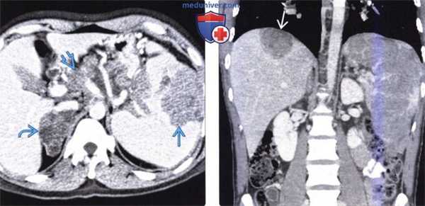 КТ, МРТ, УЗИ, ПЭТ при метастазе в селезенку и лимфоме селезенки