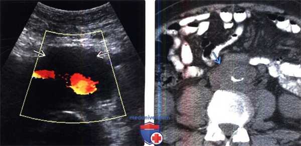 Лучевая диагностика ретроперитонеальной и мезентериальной лимфомы