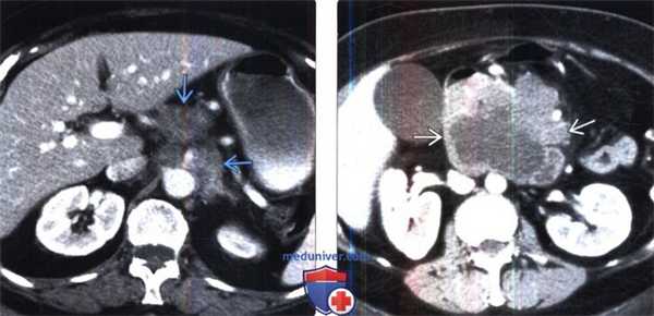 Лучевая диагностика ретроперитонеальной и мезентериальной лимфомы