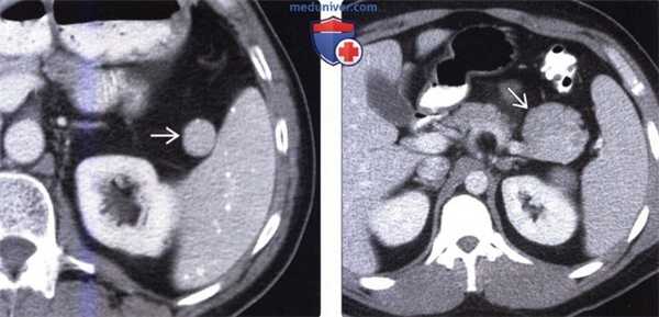 Лучевая диагностика добавочной селезенки