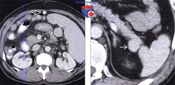 Лучевая диагностика добавочной селезенки