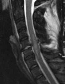 Миеломаляция