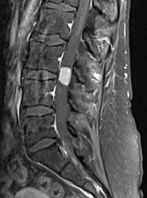 менингиома-поясн