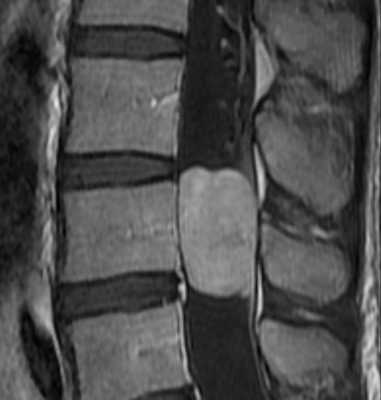 микс-эпендимома