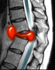 повреждение спинного мозга