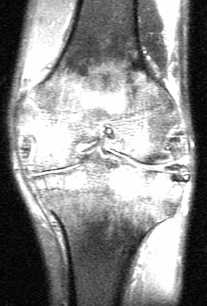 ревматоидный артрит-колено