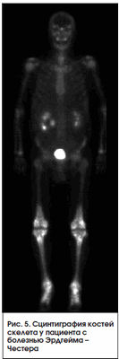 Рис. 5. Сцинтиграфия костей скелета у пациента с болезнью Эрдгейма - Честера