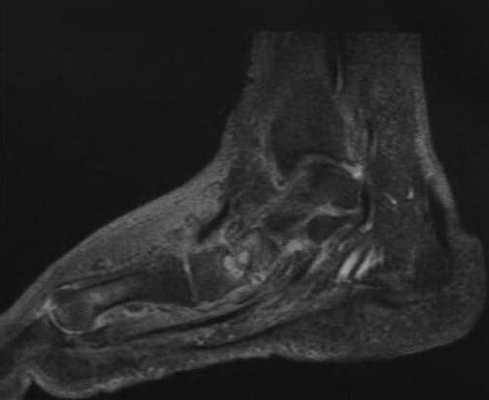 Снимки МРТ и КТ. Нейропатическая остеоартропатия 