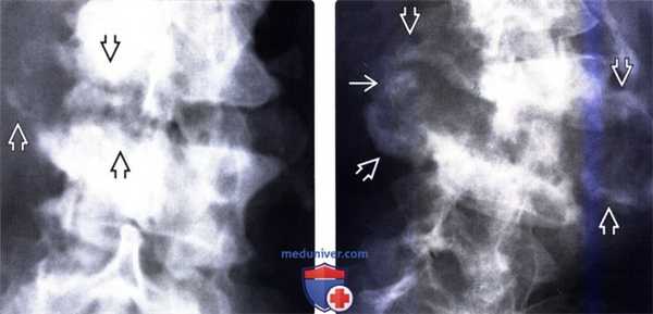КТ, МРТ позвоночника при нейрогенной артропатии Шарко