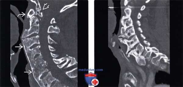 КТ, МРТ позвоночника при диффузном идиопатическом скелетном гиперостозе (ДИСГ)