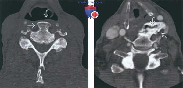 Рентгенограмма, КТ, МРТ при диффузном идиопатическом скелетном гиперостозе