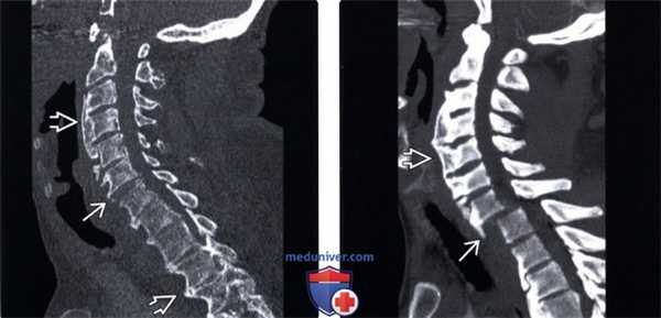 КТ, МРТ позвоночника при диффузном идиопатическом скелетном гиперостозе (ДИСГ)