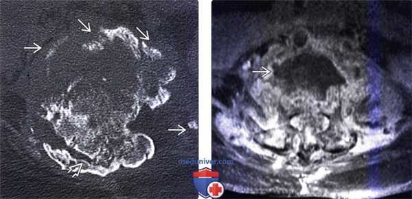 КТ, МРТ позвоночника при нейрогенной артропатии Шарко