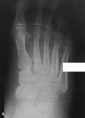 Снимки МРТ и КТ. Нейропатическая остеоартропатия 