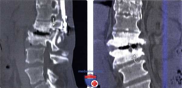 КТ, МРТ позвоночника при нейрогенной артропатии Шарко