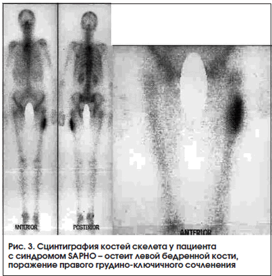 Рис. 3. Сцинтиграфия костей скелета у пациента с синдромом SAPHO - остеит левой бедренной кости, поражение правого грудино-ключичного сочленения