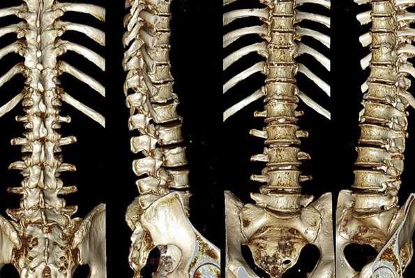 Трехмерная реконструкция при КТ