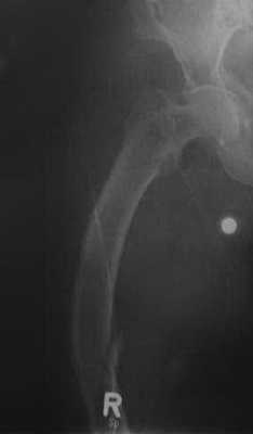 Снимки МРТ и КТ. Несовершенный остеогенез-синдром Лобштейна 