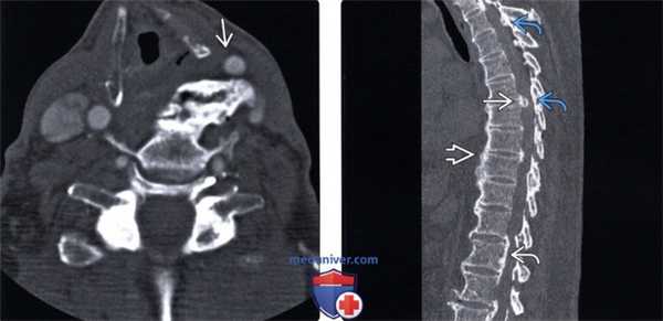 КТ, МРТ позвоночника при диффузном идиопатическом скелетном гиперостозе (ДИСГ)
