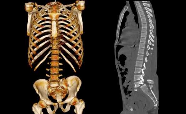Перелом со смещением в области крестцово-копчикового отдела 