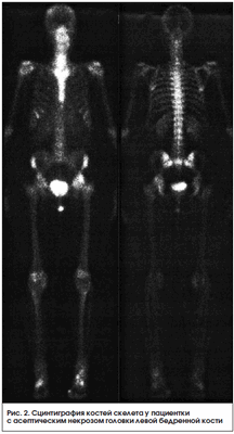 Рис. 2. Сцинтиграфия костей скелета у пациентки с асептическим некрозом головки левой бедренной кости