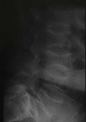 Снимки МРТ и КТ. Несовершенный остеогенез-синдром Лобштейна 