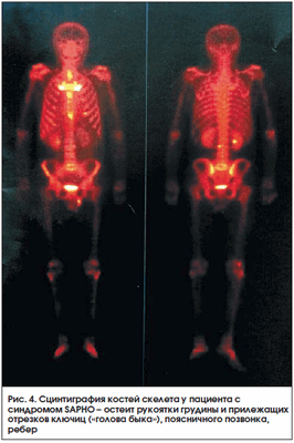 Рис. 4. Сцинтиграфия костей скелета у пациента с синдромом SAPHO - остеит рукоятки грудины и прилежащих отрезков ключиц («голова быка»), поясничного позвонка, ребер