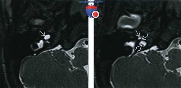Гипоплазия улитки - лучевая диагностика
