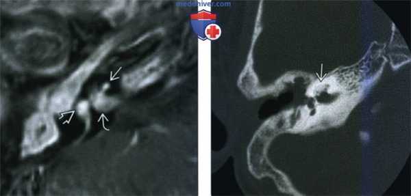КТ, МРТ при оссифицирующем лабиринтите