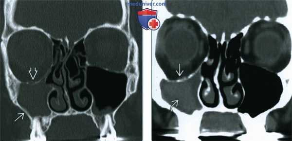 Синдром немой пазухи - лучевая диагностика