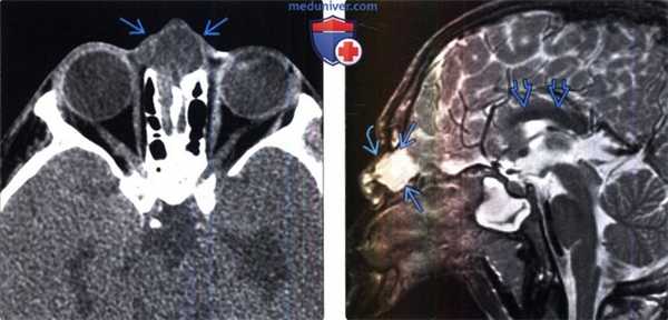 Цефалоцеле на КТ, МРТ