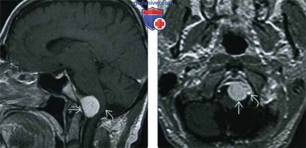 КТ, МРТ при менингиоме основания черепа