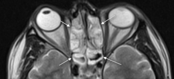 Концентрическая воспалительная гипертрофия ячеек решетчатой кости