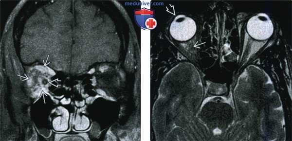 КТ, МРТ при идиопатическом воспалении глазницы (псевдотуморе)