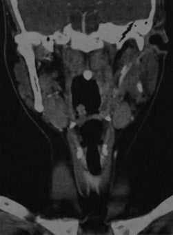 Снимки МРТ и КТ. Перитонзилярный абсцесс