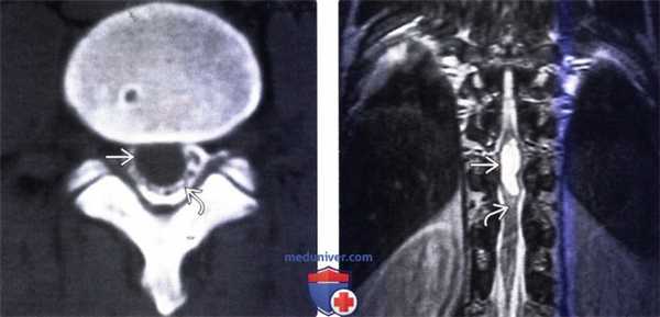 КТ, МРТ при цистицеркозе позвоночника