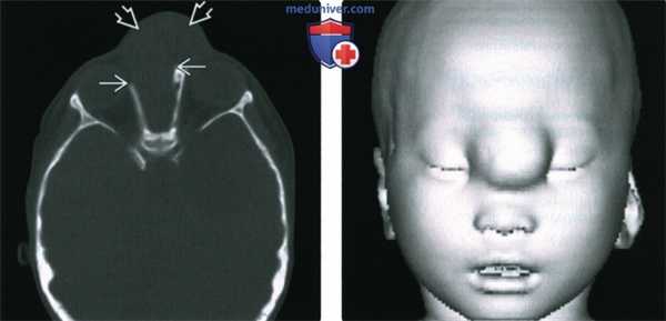 КТ, МРТ при фронтоэтмоидальном цефалоцеле