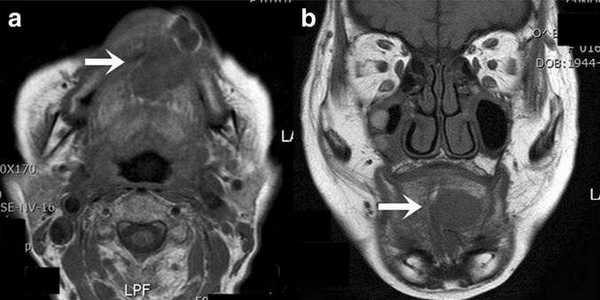 Шваннома языка на МРТ