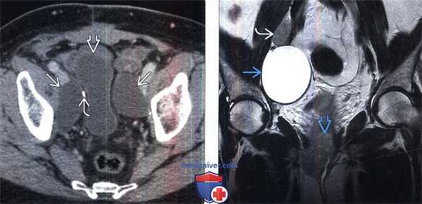 КТ, МРТ, УЗИ при послеоперационном лимфоцеле