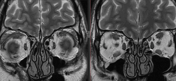 Противопоказания к магнитно-резонансной томографии глаза 