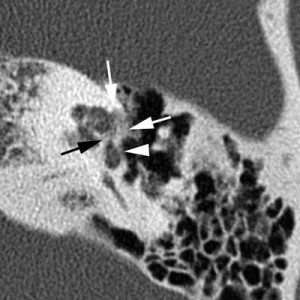 Отосклероз КТ