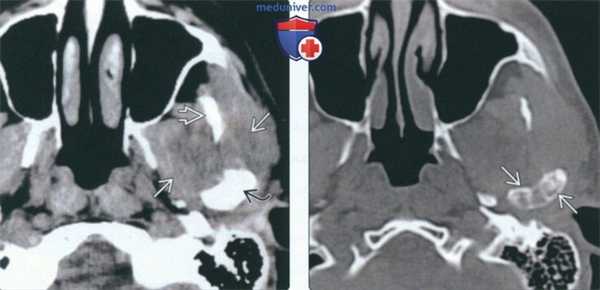 КТ, МРТ при хондросаркоме жевательного пространства