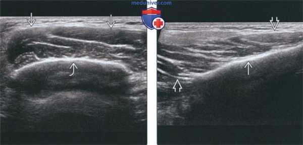 УЗ-признаки доброкачественной гипертрофии жевательной мышцы