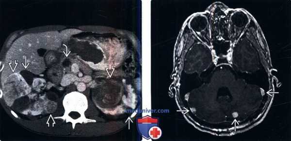 КТ, МРТ при болезни Гиппеля-Линдау