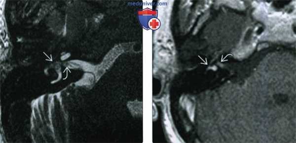 КТ, МРТ при интралабиринтной шванноме