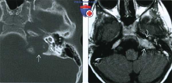 КТ, МРТ при лангергансоклеточном гистиоцитозе основания черепа