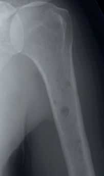 Литический очаг в плечевой кости.